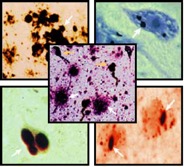 Molecular chaperones and protein aggregation